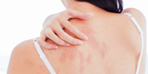 Dermatitis Skin Cream Treatment NZ